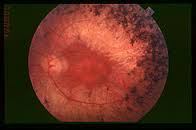 retinosis pigmentaria
